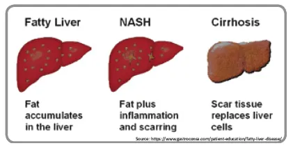 Stages of Liver Damage - NASH