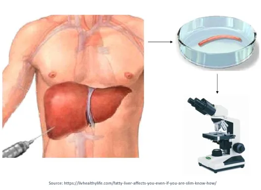 Diagnosis of NASH