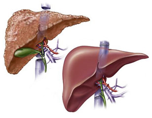 Liver Transplant Surgeon In Mumbai