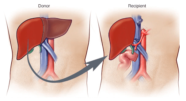 Liver Transplant Surgeon In Mumbai